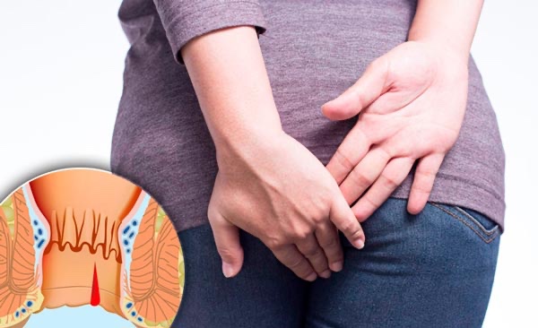 Get Rid of Anal Fissures & Hemorrhoids in a Week Without Pain or Surgery